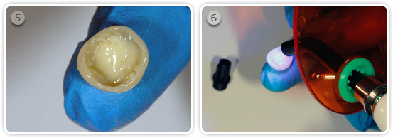 Help for the Insertion of the Pediatric crowns - Better fitting of crowns with flow komposite Step 5 and 6